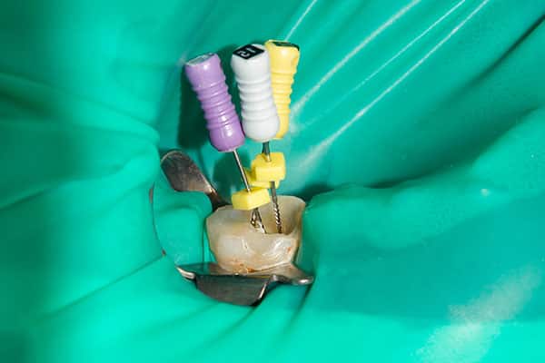 Zahnarzt Blumer Endodontologie